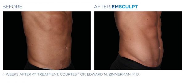 Emsculpt Before And After | Real Patient Results