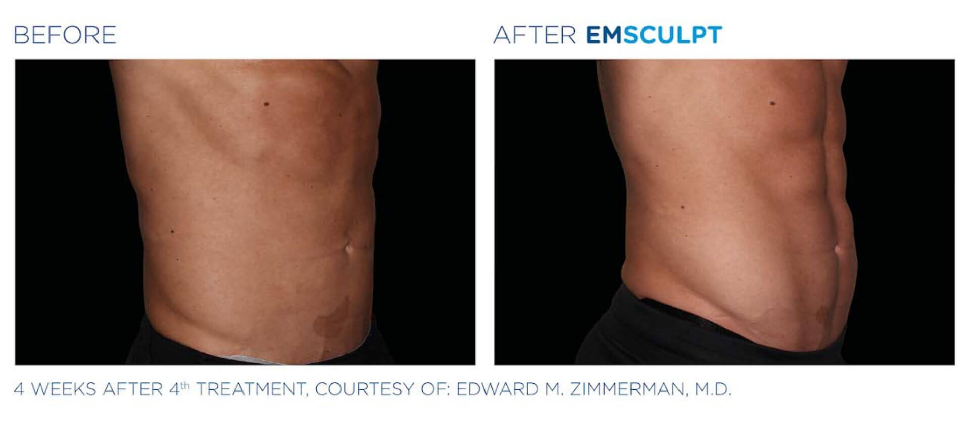 Emsculpt Before And After | Real Patient Results