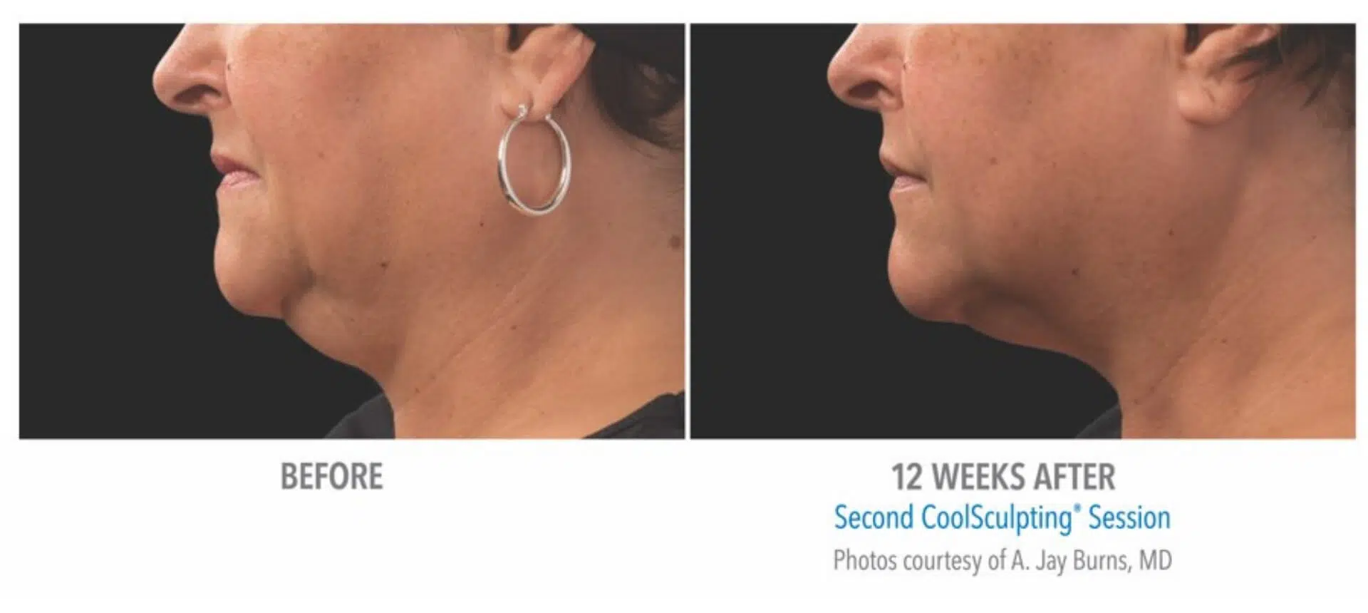 CoolSculpting Before and After Images