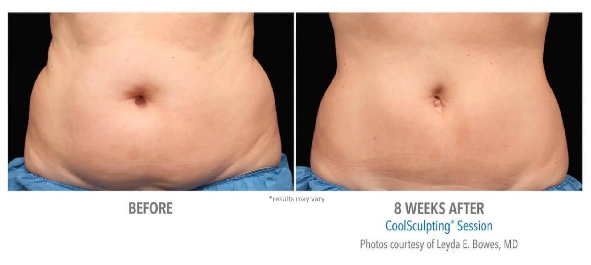 Coolsculpting Before and After Results & Review [Fat Freezing Results]