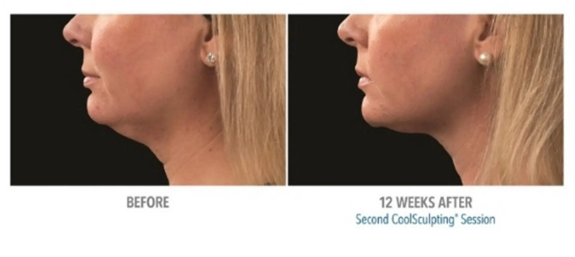 Coolsculpting Before And After Real Patient Results