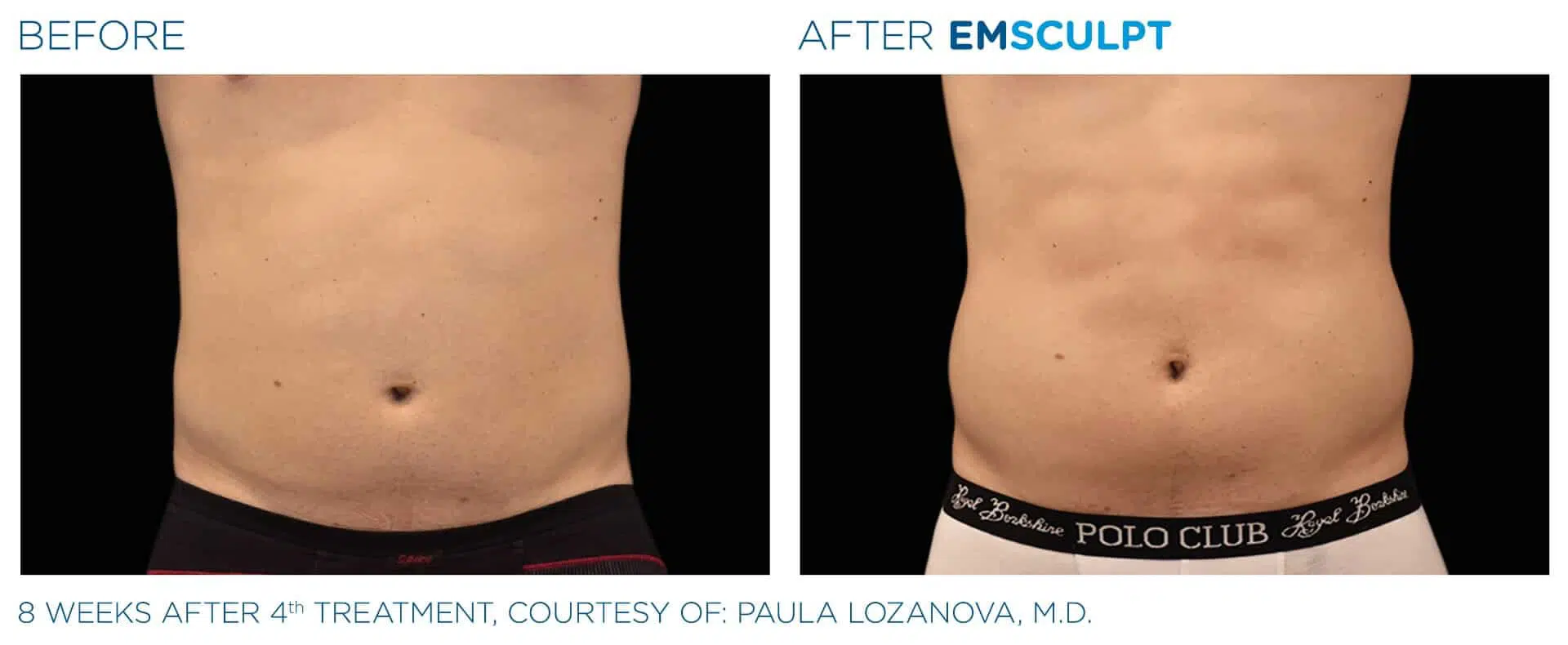 The New Emsculpt NEO  for Muscle and Fat in Middleboro, MA