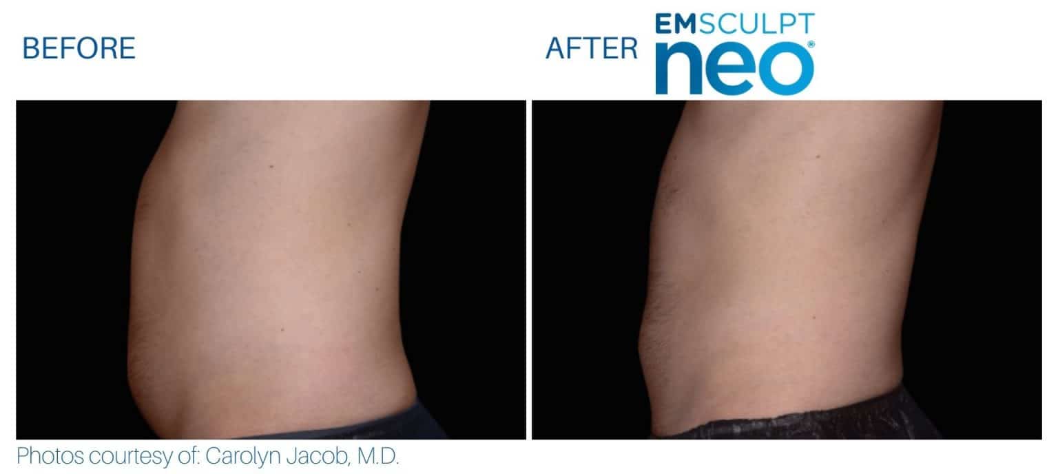 Emsculpt NEO Before And After | Real Patient Results