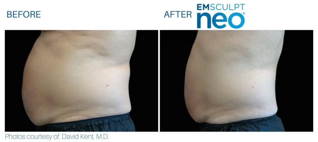 Emsculpt NEO Before and After | Real Patient Results