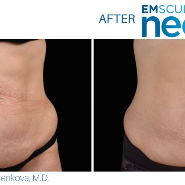 emsculpt neo before and after