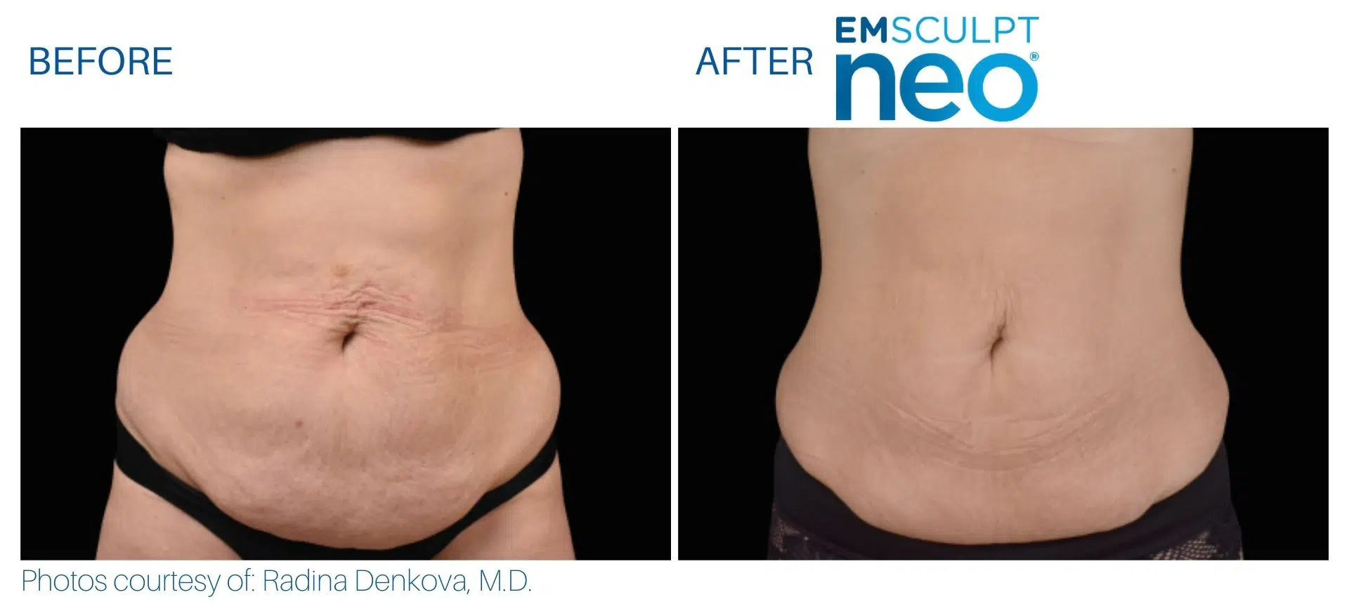 Emsculpt NEO Before and After