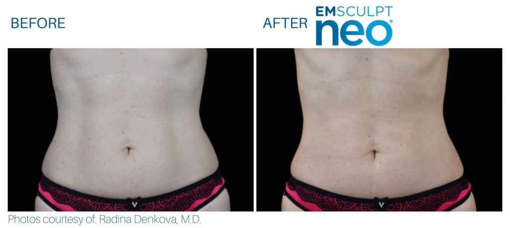 Emsculpt NEO Before and After | Real Patient Results