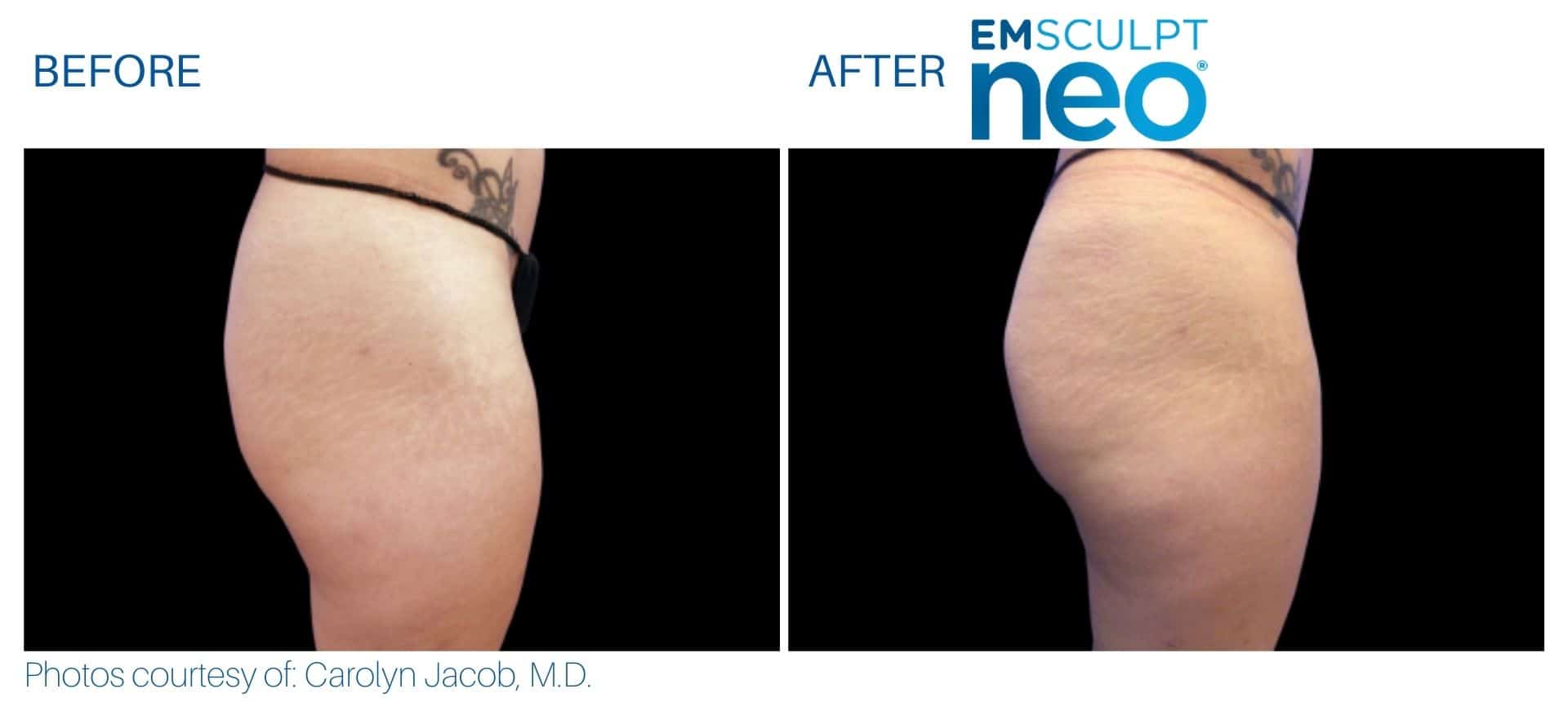 Emsculpt Neo Butt Lifts Explained: With BeforeAfter Pictures