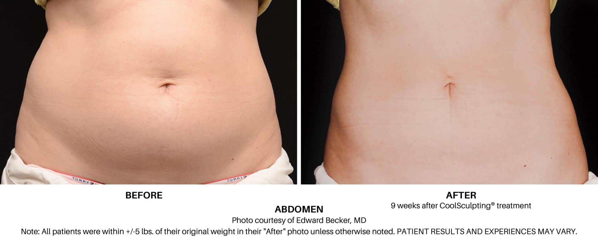 Coolsculpting Elite Before And After Pictures Proof Fat Freezing Works 2496