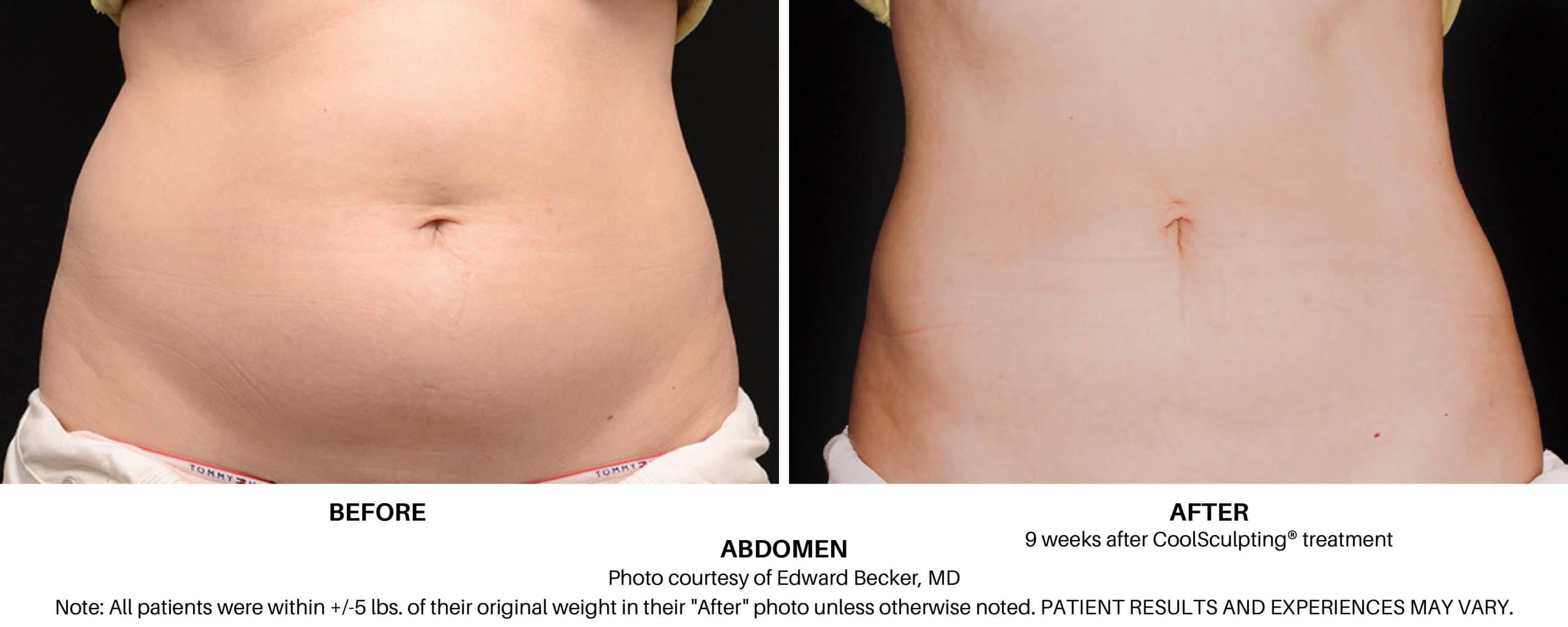 CoolSculpting Elite Before and After Pictures Proof Fat Freezing Works