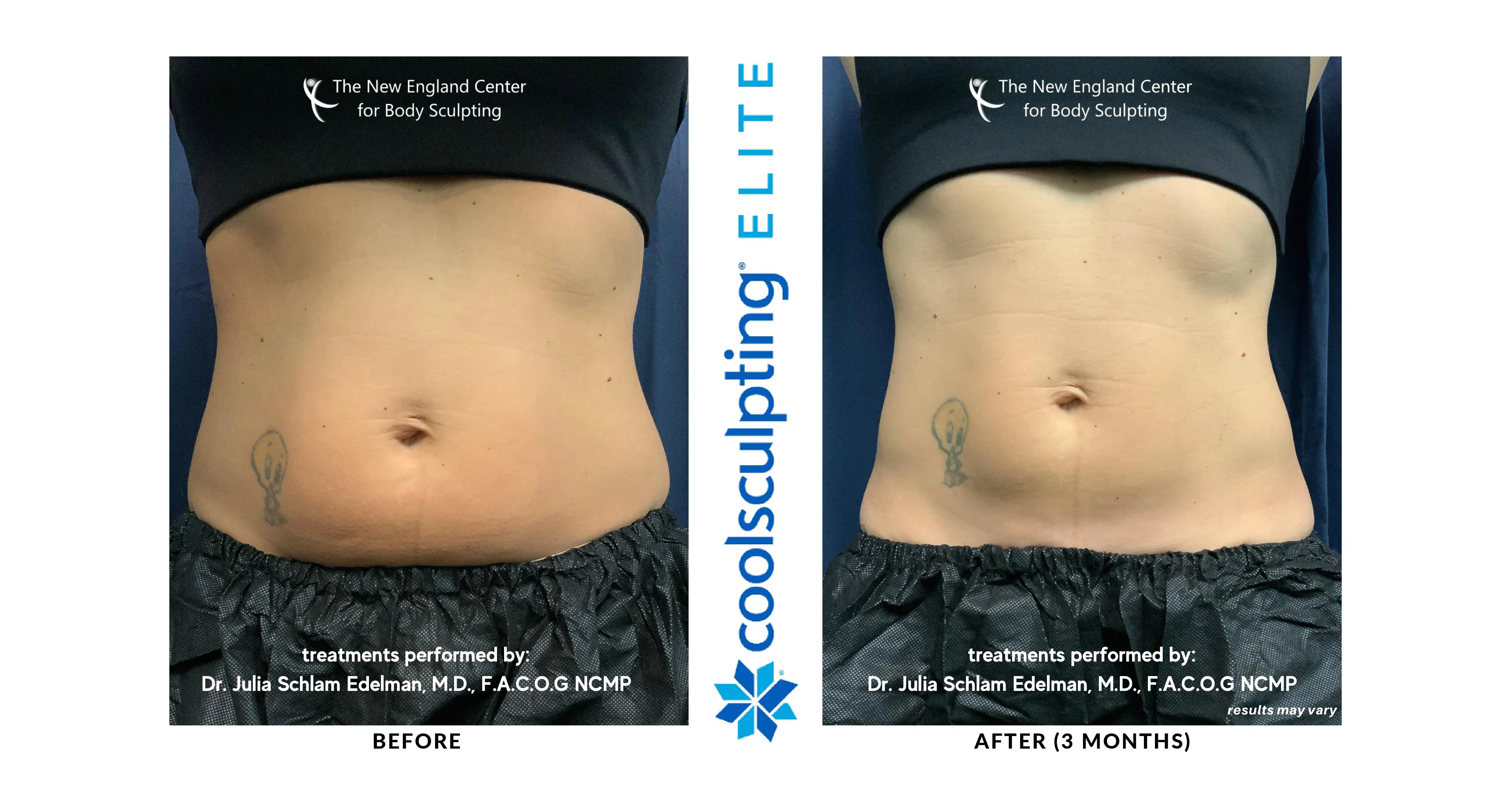 Laser Lipo vs. CoolSculpting Elite: Which Is Best for You?