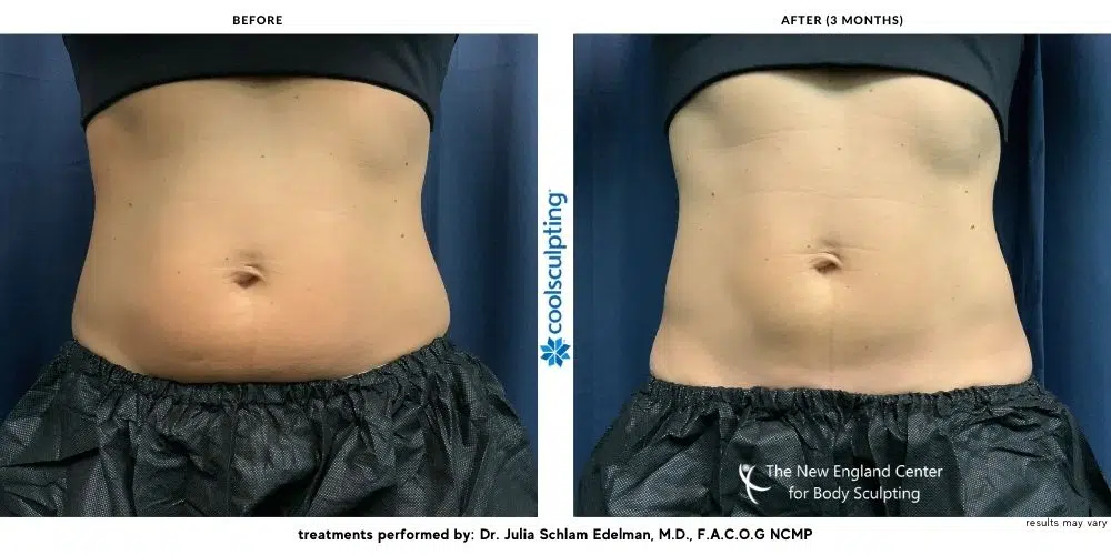 CoolSculpting Before and after Images