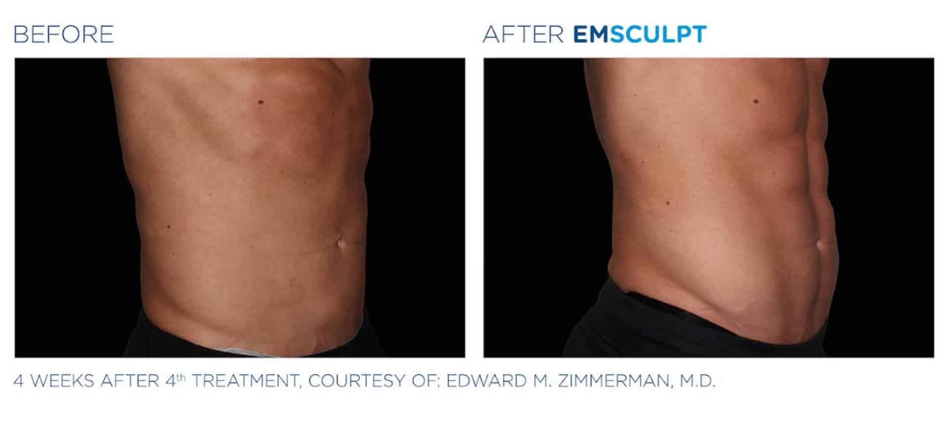Emsculpt Before and After