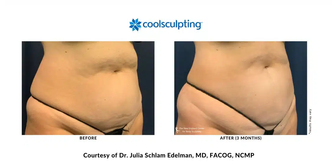 How Many CoolSculpting® Elite Treatments Are Needed for the