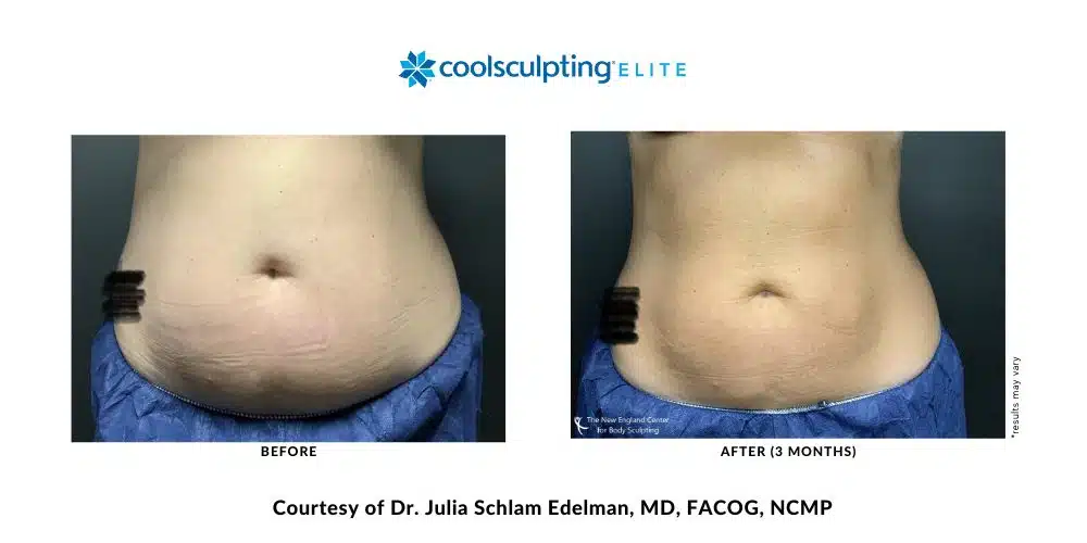 coolsculpting-elite-dr-julia-edelman-middleboro-ma-coolsculpting-before-and-after-mobile-1