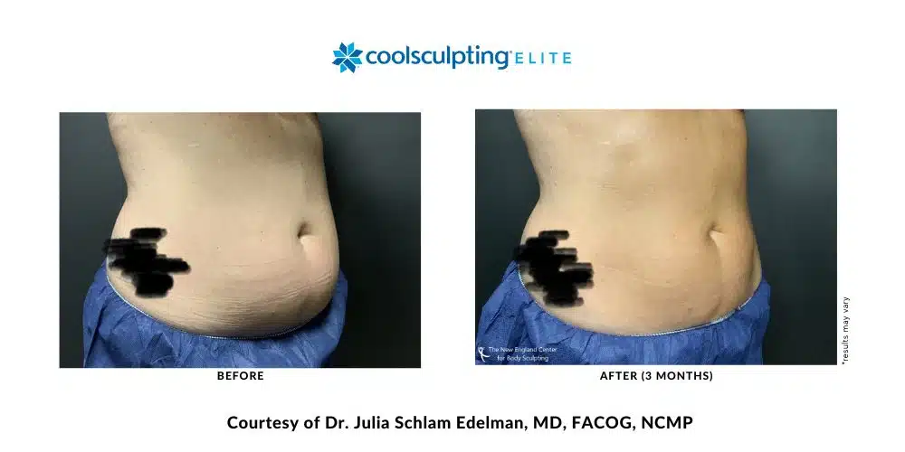 coolsculpting-elite-dr-julia-edelman-middleboro-ma-coolsculpting-before-and-after-mobile-2