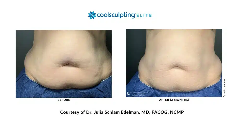 coolsculpting-elite-dr-julia-edelman-middleboro-ma-coolsculpting-before-and-after-mobile-3