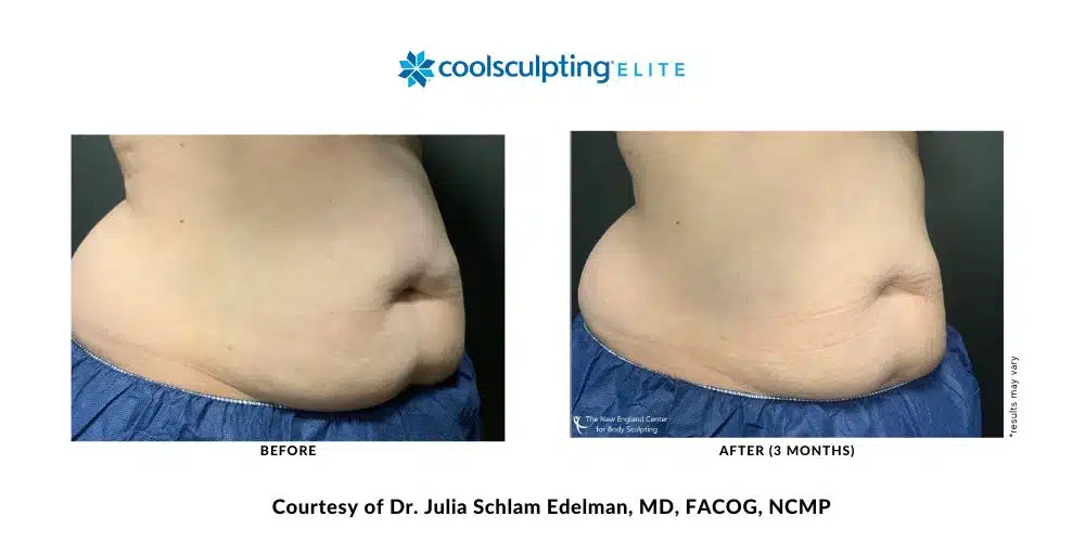 coolsculpting-elite-dr-julia-edelman-middleboro-ma-coolsculpting-before-and-after-mobile-4
