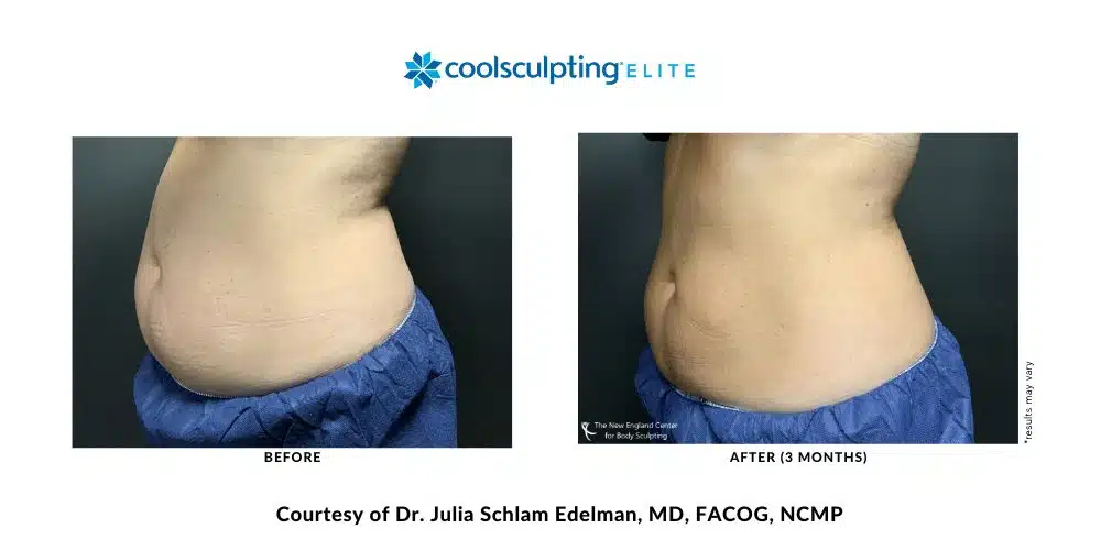 coolsculpting-elite-dr-julia-edelman-middleboro-ma-coolsculpting-before-and-after-mobile-5